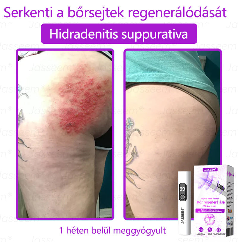 đđđŹđŹđđđŠÂź Fejlett, nem invazĂv bĆrjavĂtĂł COâ lĂ©zeres toll đ (GyengĂ©den eltĂĄvolĂtja a szemölcsöket, anyajegyeket, öregsĂ©gi foltokat Ă©s bĆrkinövĂ©seket â fĂĄjdalom Ă©s gond nĂ©lkĂŒl!)