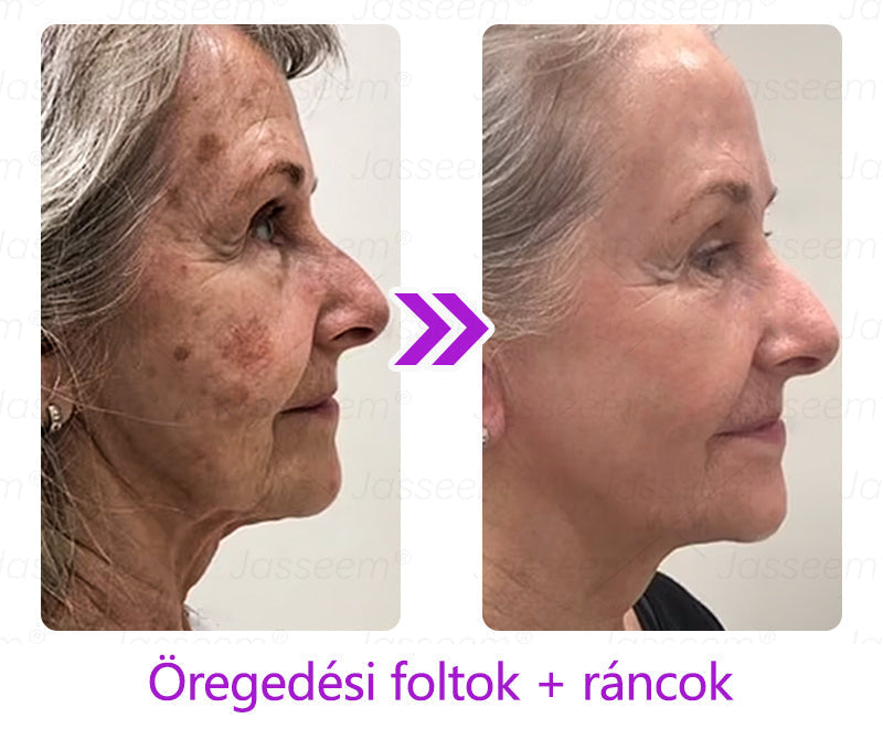 đđđŹđŹđđđŠÂź Fejlett, nem invazĂv bĆrjavĂtĂł COâ lĂ©zeres toll đ (GyengĂ©den eltĂĄvolĂtja a szemölcsöket, anyajegyeket, öregsĂ©gi foltokat Ă©s bĆrkinövĂ©seket â fĂĄjdalom Ă©s gond nĂ©lkĂŒl!)