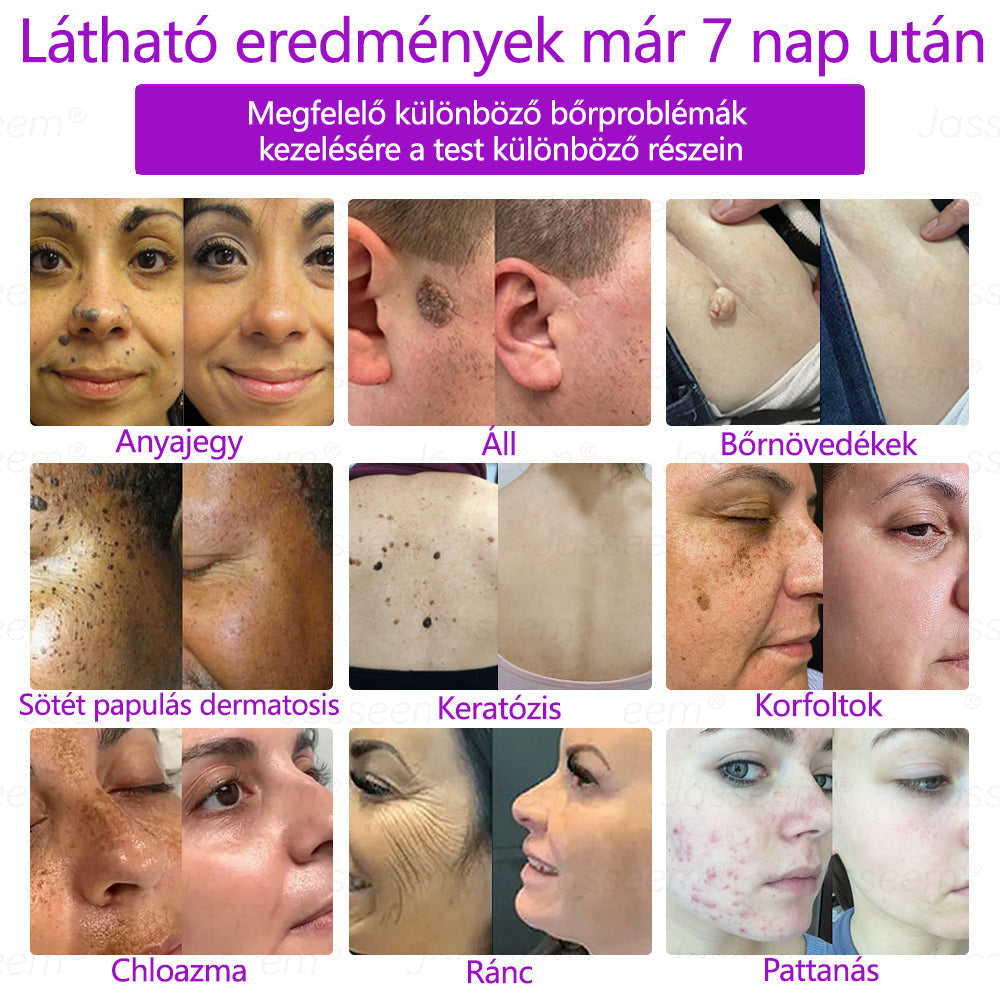 đđđŹđŹđđđŠÂź Fejlett, nem invazĂv bĆrjavĂtĂł COâ lĂ©zeres toll đ (GyengĂ©den eltĂĄvolĂtja a szemölcsöket, anyajegyeket, öregsĂ©gi foltokat Ă©s bĆrkinövĂ©seket â fĂĄjdalom Ă©s gond nĂ©lkĂŒl!)