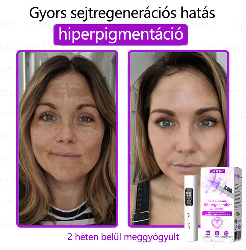 đđđŹđŹđđđŠÂź Fejlett, nem invazĂv bĆrjavĂtĂł COâ lĂ©zeres toll đ (GyengĂ©den eltĂĄvolĂtja a szemölcsöket, anyajegyeket, öregsĂ©gi foltokat Ă©s bĆrkinövĂ©seket â fĂĄjdalom Ă©s gond nĂ©lkĂŒl!)