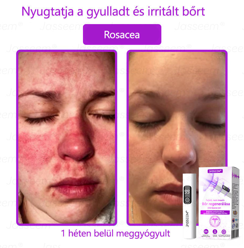 đđđŹđŹđđđŠÂź Fejlett, nem invazĂv bĆrjavĂtĂł COâ lĂ©zeres toll đ (GyengĂ©den eltĂĄvolĂtja a szemölcsöket, anyajegyeket, öregsĂ©gi foltokat Ă©s bĆrkinövĂ©seket â fĂĄjdalom Ă©s gond nĂ©lkĂŒl!)