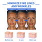 BOTOX ARCSZÉRUM | VEGYÉL 1-ET ÉS KAPSZ 1-ET INGYEN
