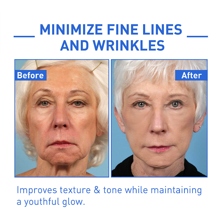 BOTOX ARCSZÉRUM | VEGYÉL 1-ET ÉS KAPSZ 1-ET INGYEN